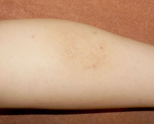 인천 부평 습진 치료 후 · 23세 여성 · 치료 기간 6개월