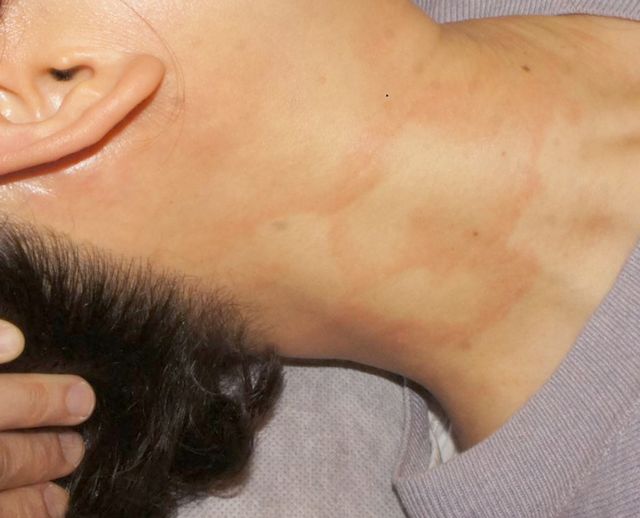 인천 부평 아토피 치료 전 · 50세 여성